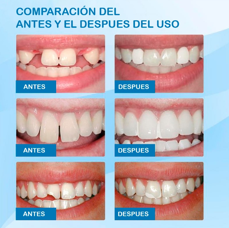 ✨ ResiSmile™ – Resina Dental Temporal – Sonríe con Confianza en Minutos