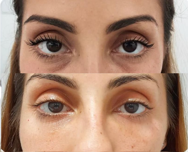 ✨Serum Ojos Radiantes™ – Suero Anti Ojeras Roll-On – Adiós a Bolsas y Ojeras en Minutos